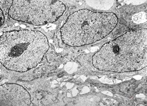 F,12y. | medulloblastoma